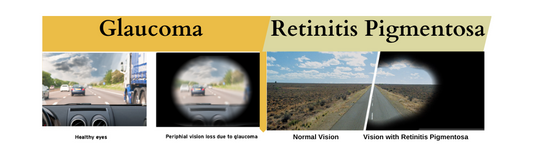 Glaucoma vs retinitis Pigmentosa Vision image 