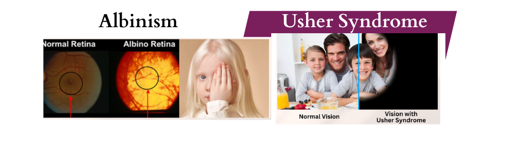 Picture of Albinism vision Versus Usher Syndrome