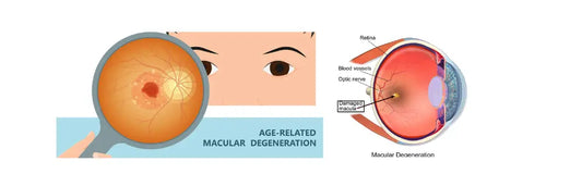 Macular Degeneration - eye image